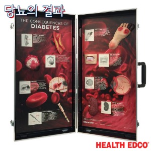 HEALTH EDCO USA 3D입체모형 78878당뇨의결과 당뇨병위험성 교육