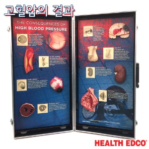 HEALTH EDCO USA 3D입체모형 78927 고혈압의결과 고혈압의 위험성 교육