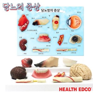 HEALTH EDCO USA 3D입체모형 78792 당뇨의증상 당뇨의위험성 교육교재