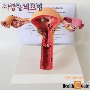 AnatomyStuff 자궁모형 G348/1 자궁질병모형 스탠드형