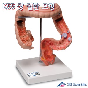 3B Scientific 인체모형 장질환모형 K55 결장과 직장사이의 각종 변병표현