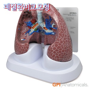 GPI USA 실제사이즈 정상폐와 폐질환 비교모형 G311 폐암 천식 COPD 폐쇄성폐질환