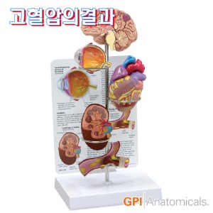 GPI USA 고혈압의결과 5종 세트 G400 뇌 심장 안구 신장 혈관