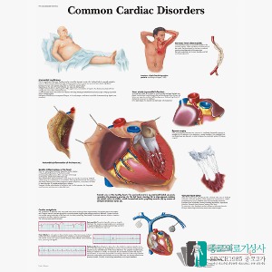 3B Scientific 심장질병 인체해부차트 VR1343 Cardiac Disorders 심장질환 병원액자