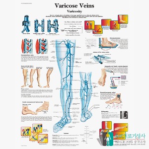 3B Scientific 정맥류 인체해부차트 VR1367 Varicose Veins 병원액자