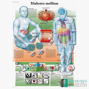 3B Scientific 당뇨의 이해 인체해부차트 VR1441 Diabetes 병원액자