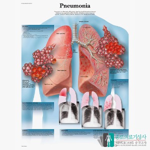 3B Scientific 폐렴 Polmonite 인체해부차트 VR1326 Pneumonia 병원액자