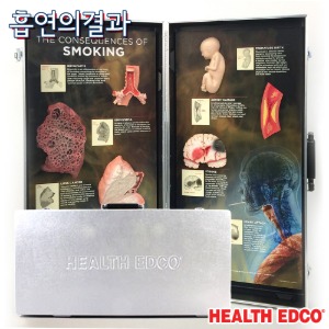 HEALTH EDCO USA 3D입체모형 79601 흡연의결과 금연교육 흡연예방교육