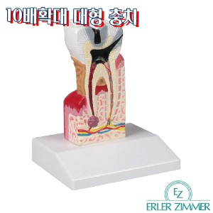 ERLER ZIMMER 인체모형 D214 10배확대 치아모형 대형충치모형