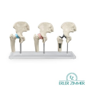 ERLER ZIMMER 인체모형 1115 고관절임플란트 3단계 대퇴골인공관절