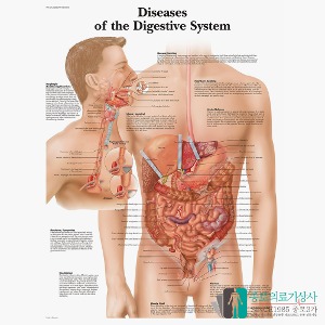 3B Scientific 소화기질병 인체해부차트 VR1431 Diseases of the Digestive System 소화계질환 병원액자