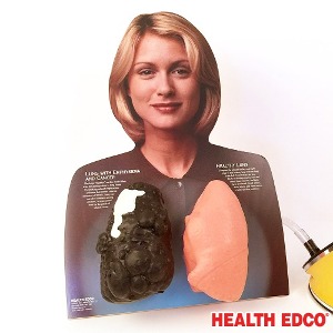 HEALTH EDCO USA 79261 루 휘즈 폐비교모형 금연교육