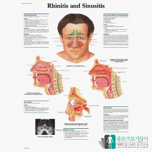 3B Scientific 비염과 축농증 인체해부차트 VR1251 Rhinitis and Sinusitis 병원액자