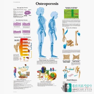 3B Scientific 골다공증 인체해부차트 VR1121 Osteoporosis 병원액자
