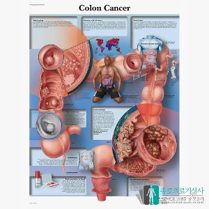 3B Scientific 대장암 Colon Cancer 인체해부차트 VR1432 대장암병변 병원액자