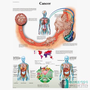 3B Scientific 암의 이해 인체해부차트 VR1753 Cancer 병원액자