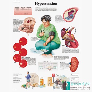 3B Scientific 고혈압의 이해 인체해부차트 VR1361 Hypertension 병원액자
