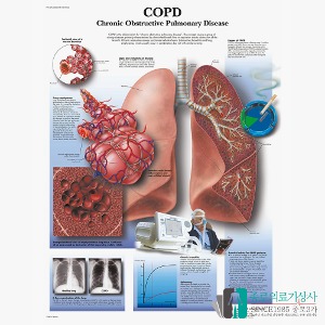 3B Scientific 폐쇄성폐질환 인체해부차트 VR1329 COPD 병원액자